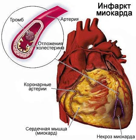 Врачи Ногайской ЦРБ предупредили о симптомах инфаркта миокарда