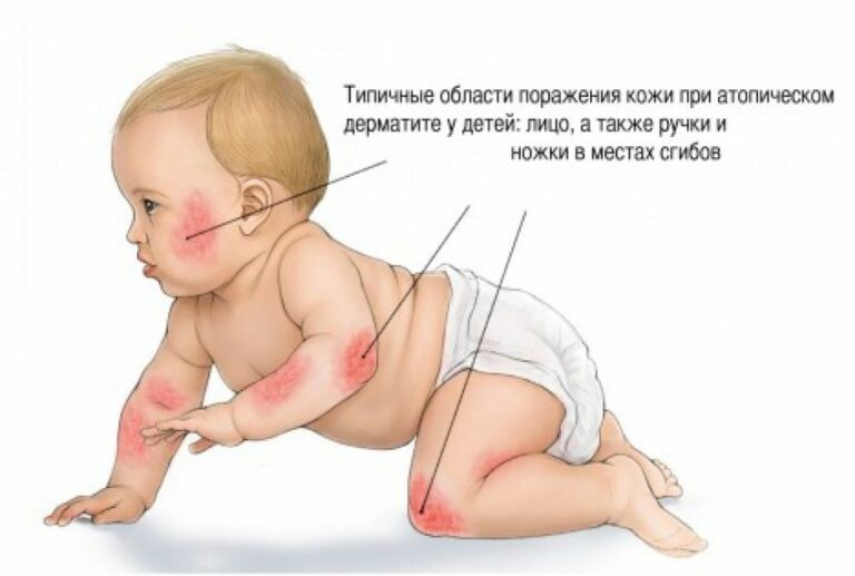 Врач Ногайской ЦРБ предупреждает население об атопическом дерматите у детей